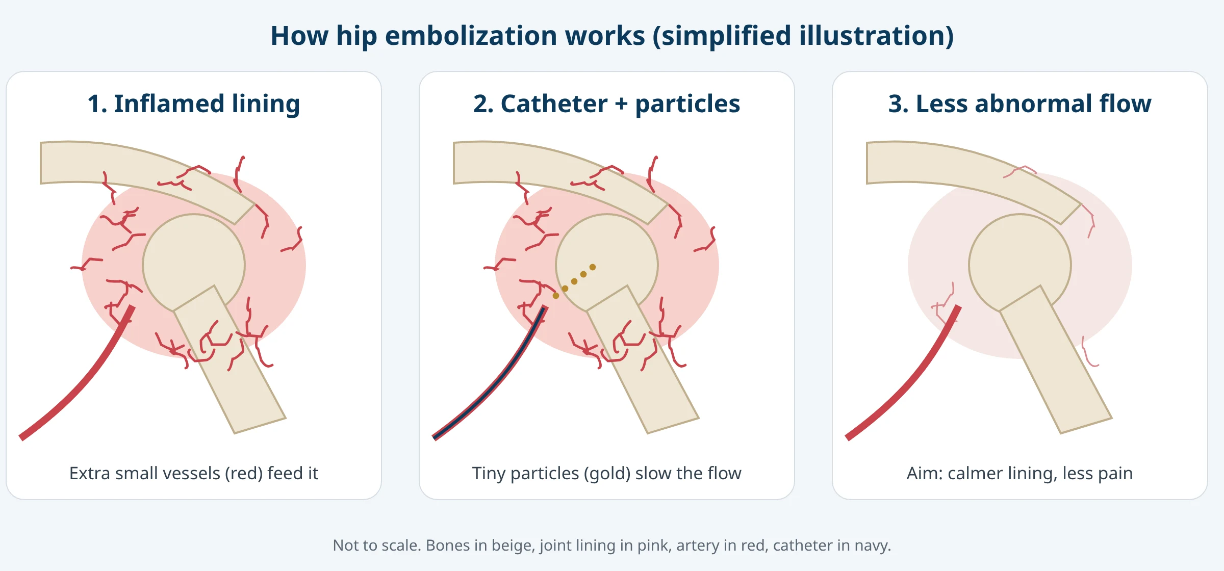Three-panel illustration: an inflamed hip lining with extra small vessels, a catheter releasing tiny particles, and reduced abnormal blood flow afterward.