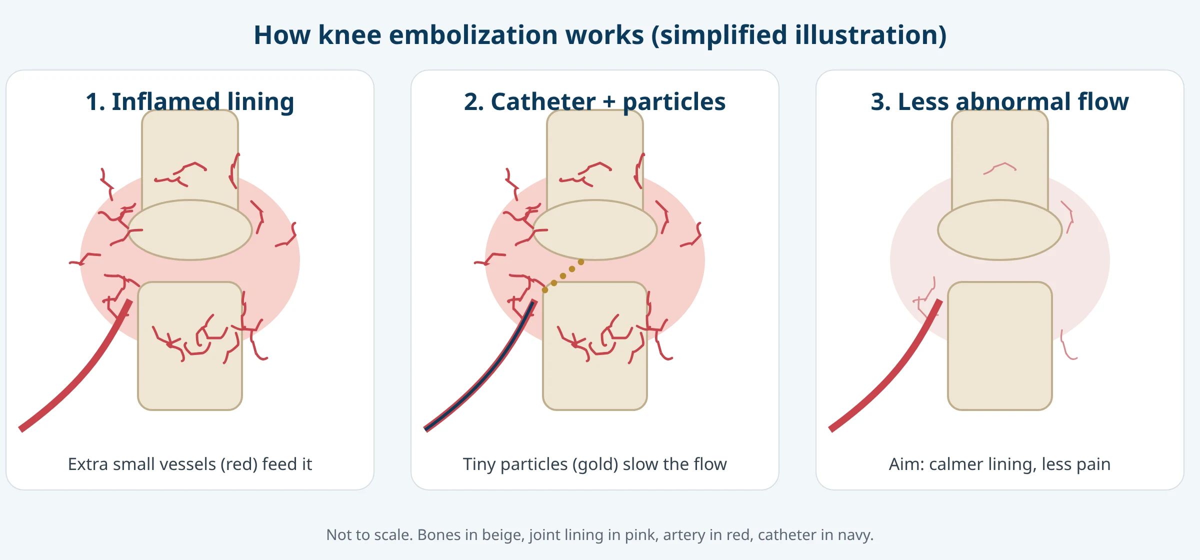 Three-panel illustration: an inflamed knee lining with extra small vessels, a catheter releasing tiny particles, and reduced abnormal blood flow afterward.