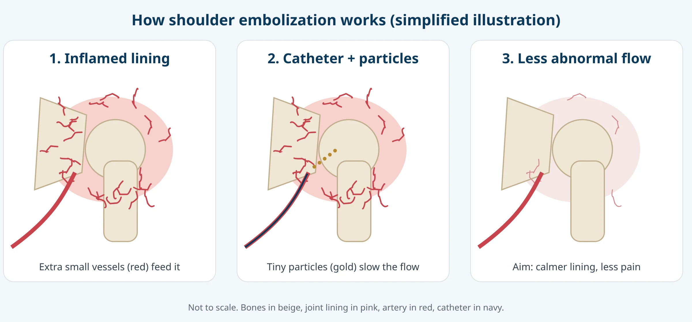 Three-panel illustration: an inflamed shoulder lining with extra small vessels, a catheter releasing tiny particles, and reduced abnormal blood flow afterward.