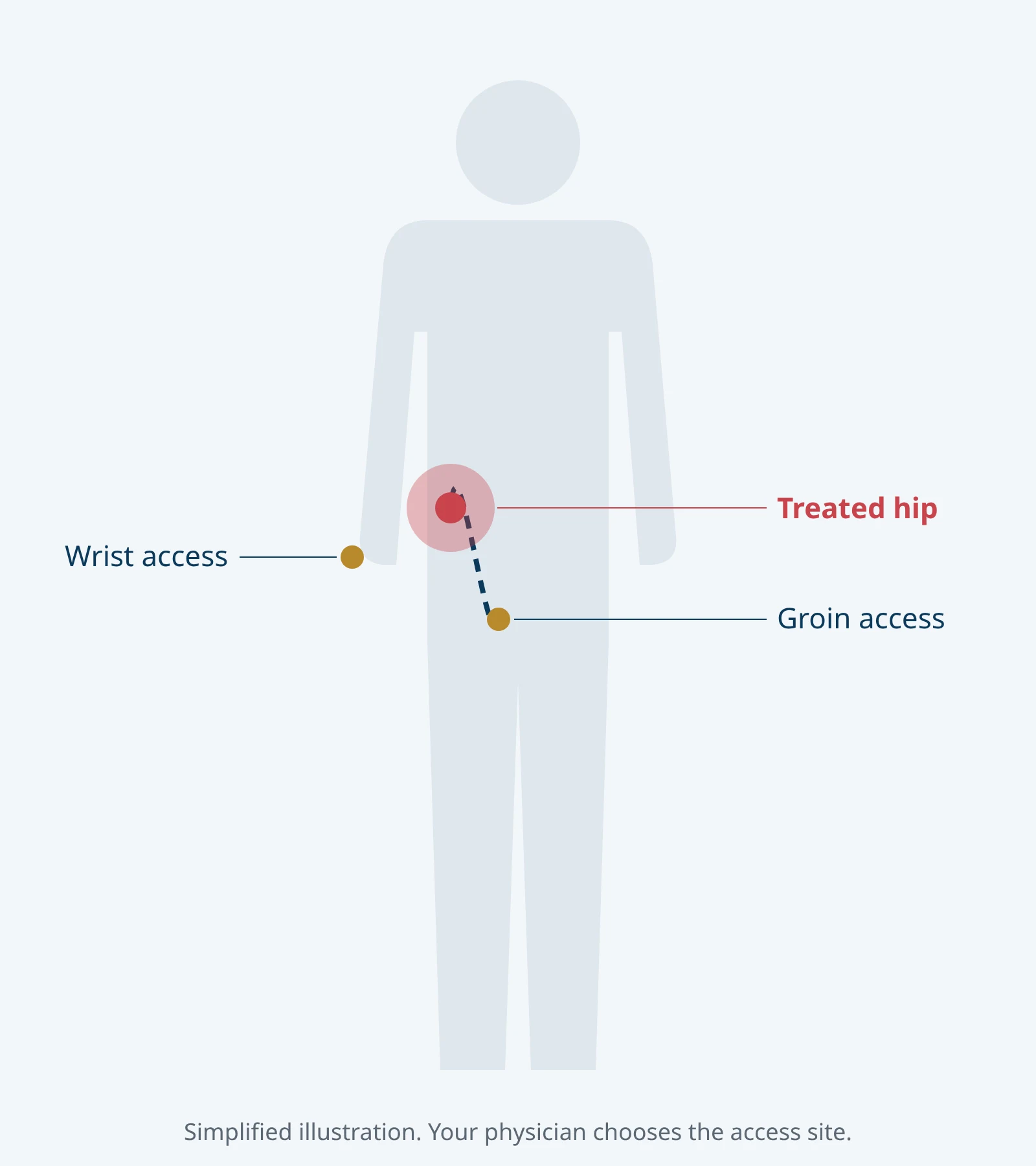 Simplified body outline showing catheter access at the wrist or groin and the treated hip.