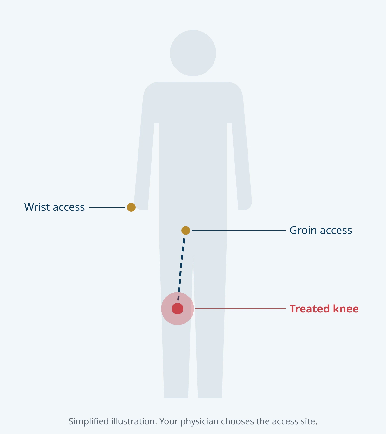 Simplified body outline showing catheter access at the wrist or groin and the treated knee.