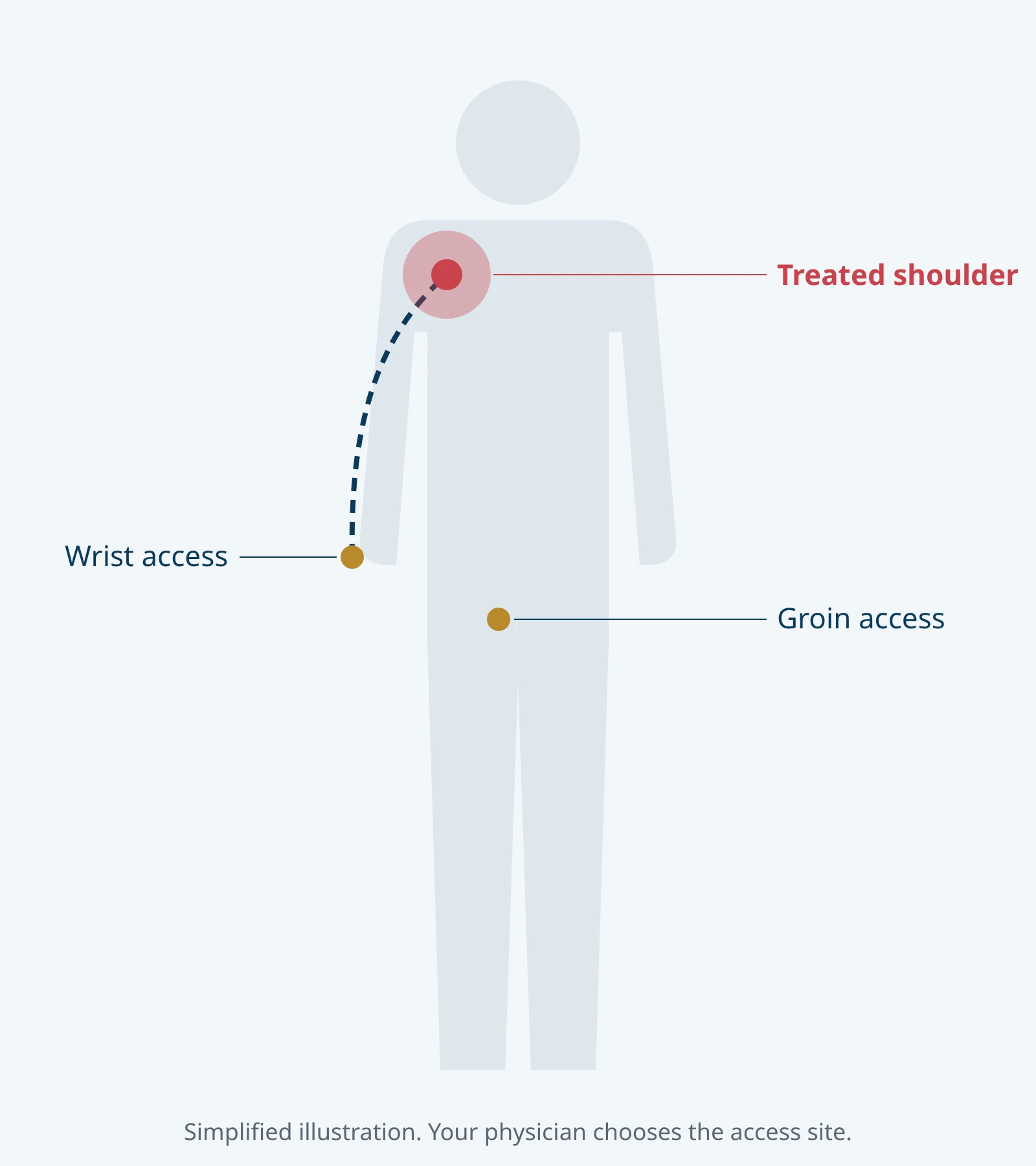 Simplified body outline showing catheter access at the wrist or groin and the treated shoulder.