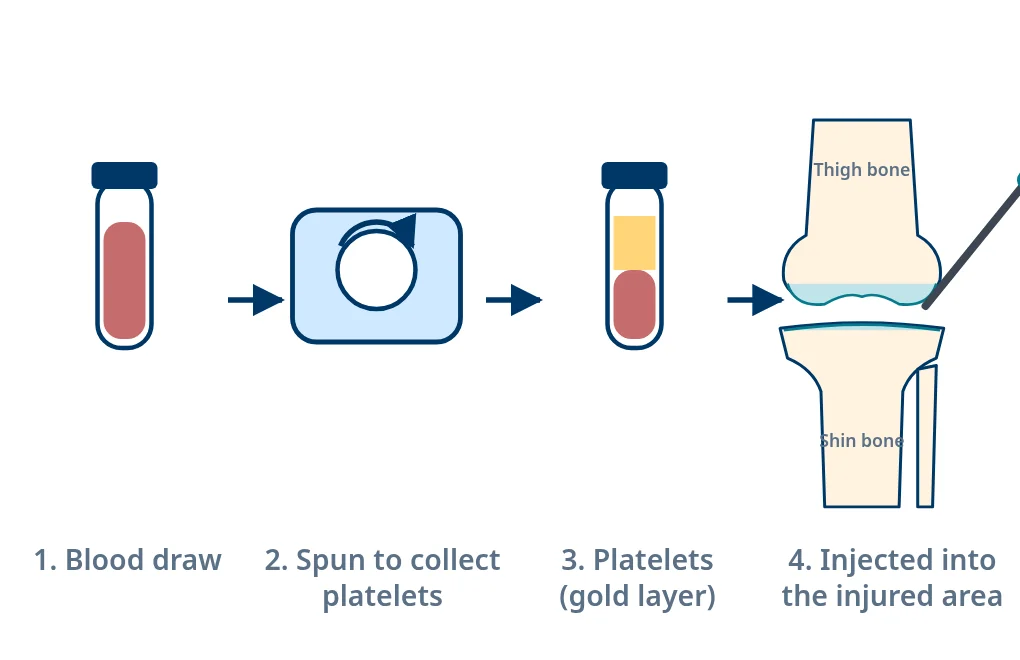 Four steps of PRP: a small blood draw, spinning the blood in a machine, collecting the platelet layer, and injecting it into the injured area.