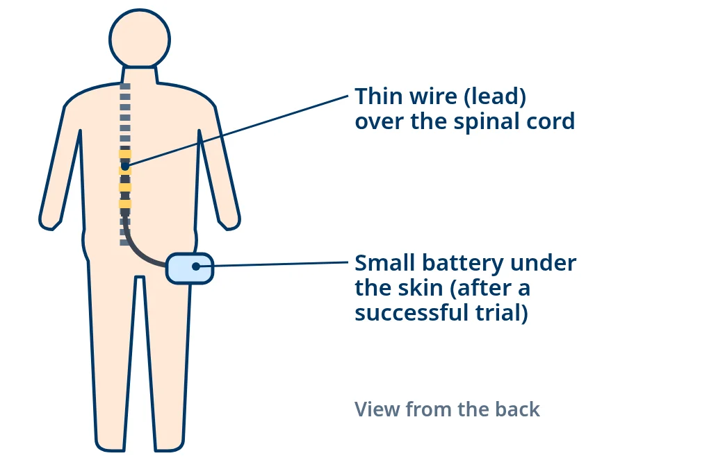 Back view of a person showing a thin stimulator wire over the spinal cord in the mid-back, connected to a small battery under the skin of the buttock or flank.