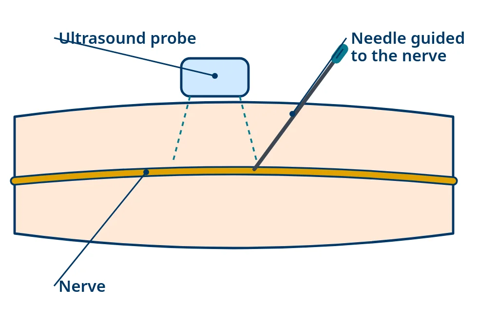 Side view of an arm with a nerve inside: an ultrasound probe on the skin shows the nerve so a needle can place medicine next to it.