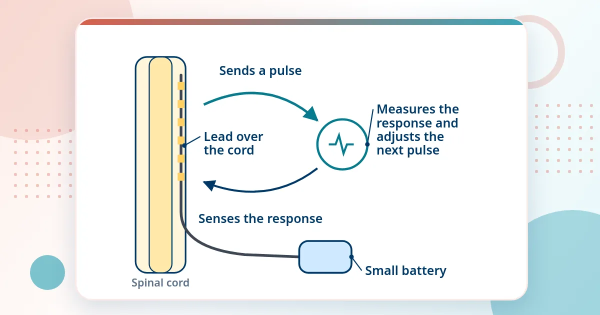 Diagram of a stimulator lead over the spinal cord in a loop: it sends a pulse, senses the spinal cord response and adjusts the next pulse, with a small battery under the skin.