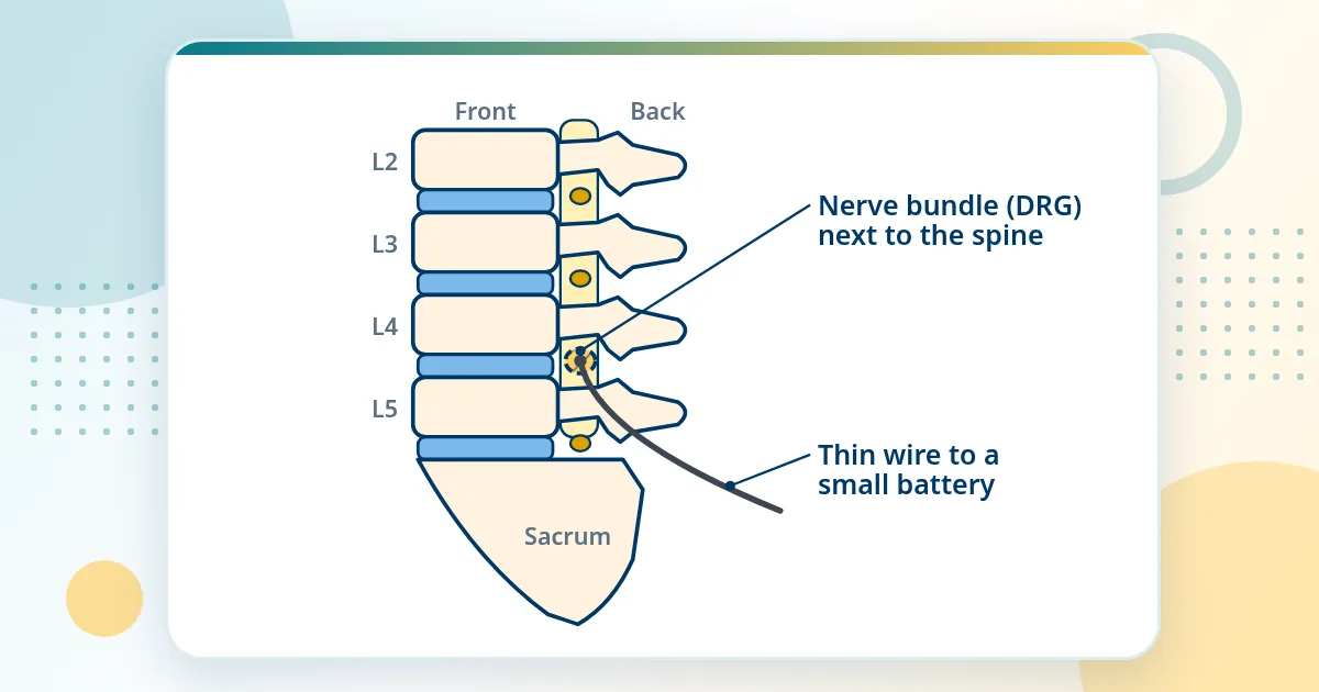 Side view of the lower spine with a thin wire placed at the small nerve bundle (dorsal root ganglion) where a nerve leaves the spine.