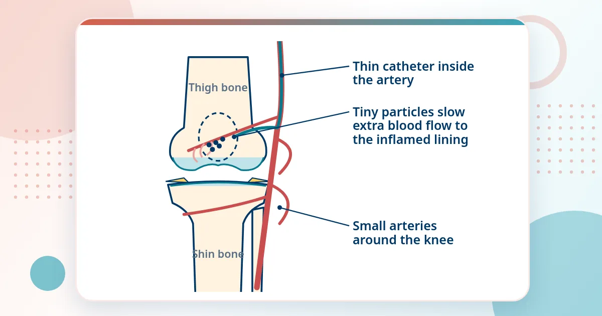 Front view of a knee with the small arteries around it drawn in red, a thin catheter inside one artery and tiny particles slowing the extra blood flow to the inflamed knee lining.