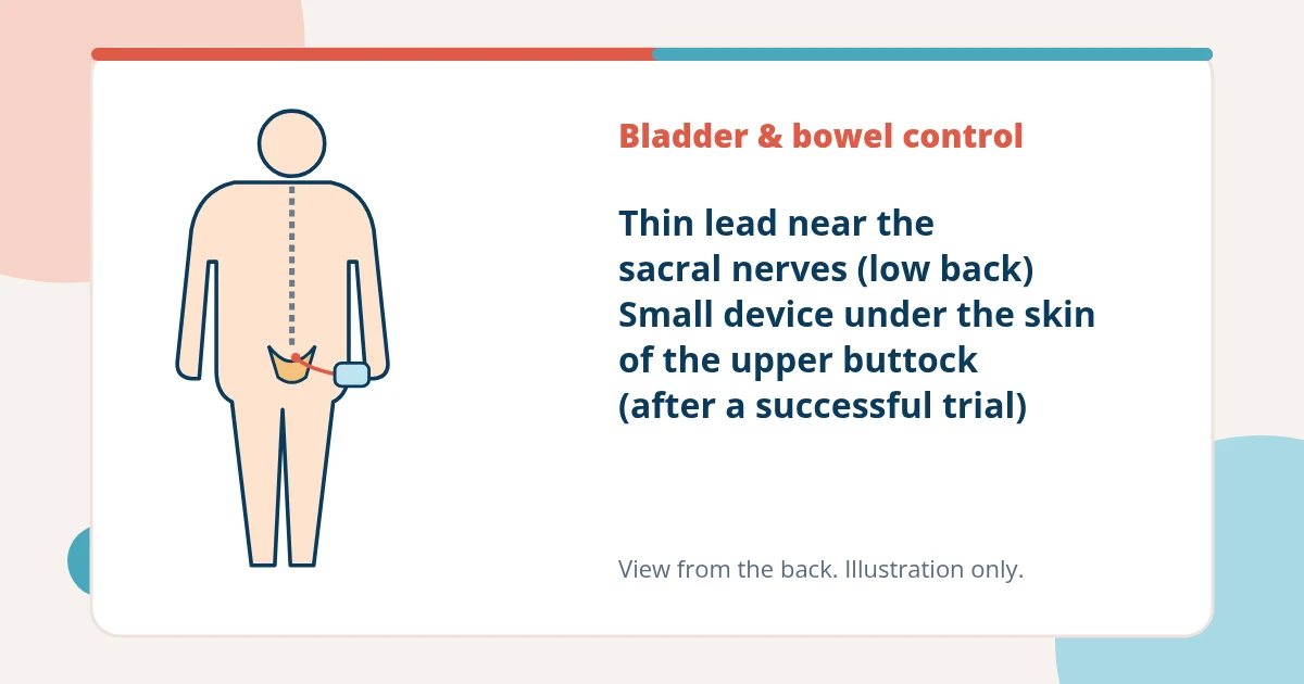 Back view illustration of a person with a thin lead near the sacral nerves in the low back connected to a small device under the skin of the upper buttock.