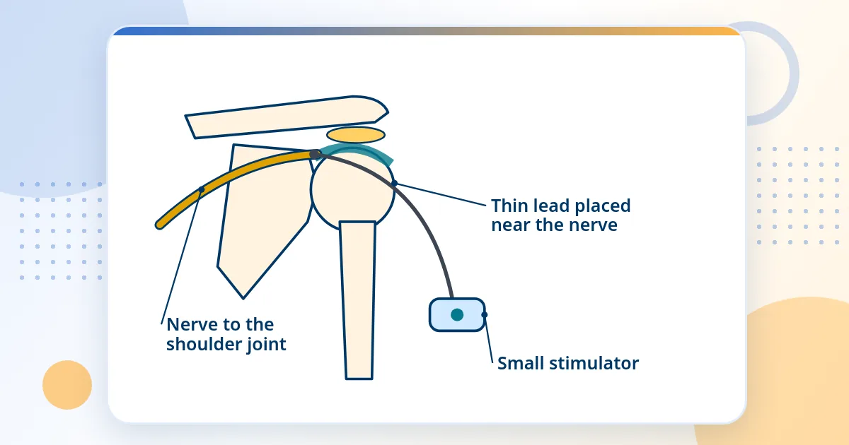 Front view of a shoulder with a nerve running to the joint, a thin wire lead placed next to the nerve and a small stimulator connected to it.