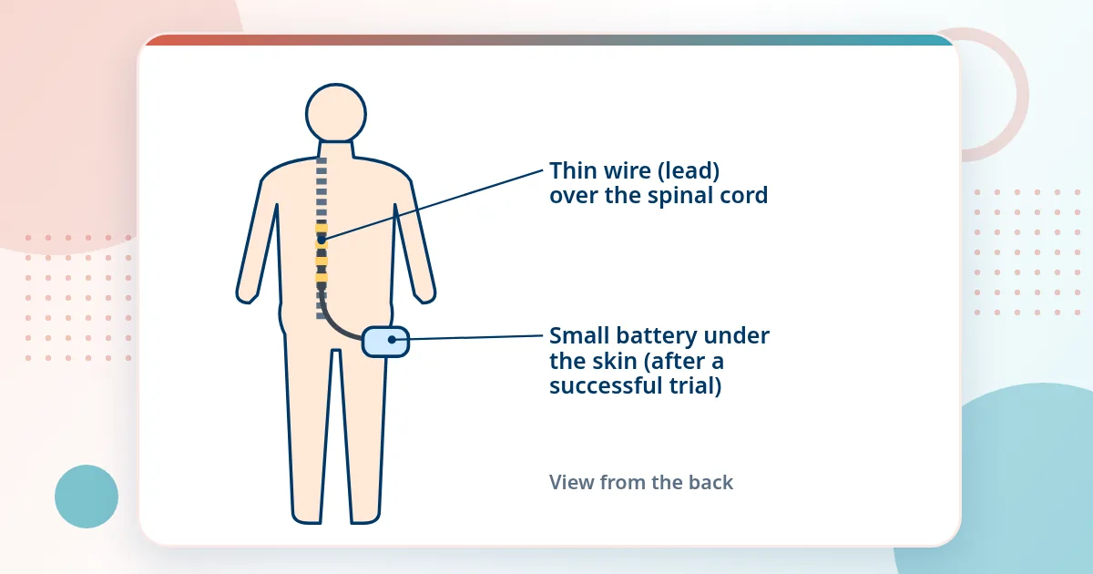 Back view of a person showing a thin stimulator wire over the spinal cord in the mid-back, connected to a small battery under the skin of the buttock or flank.