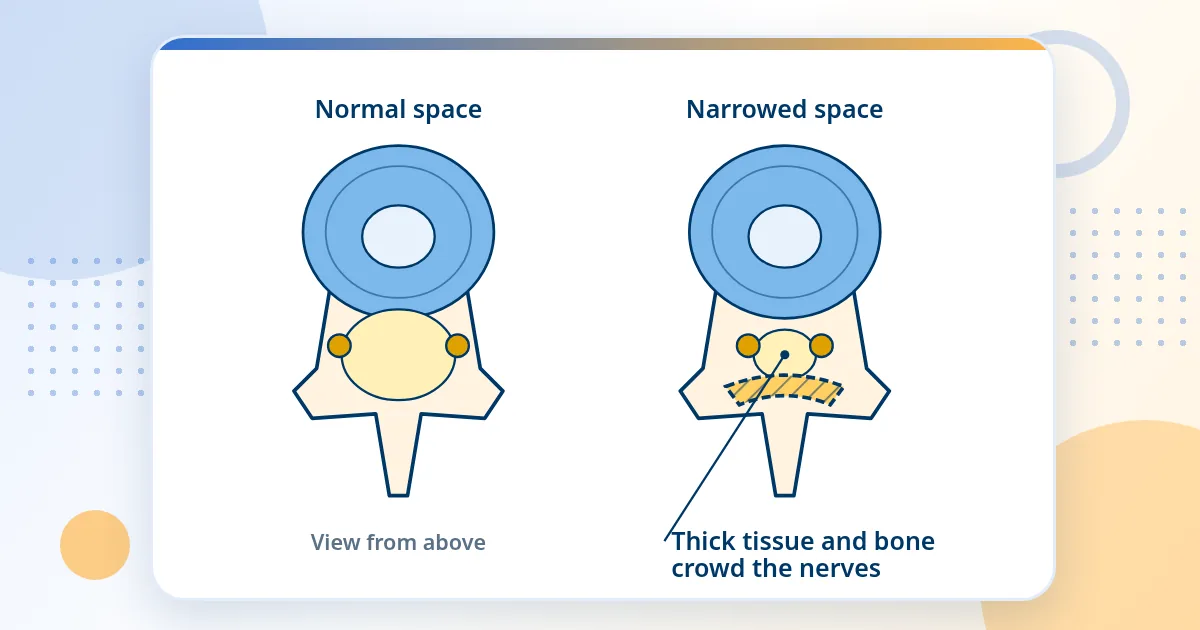 Two views from above of a spine bone: on the left a normal open space for the nerves, on the right the space is narrowed and crowds the nerves.