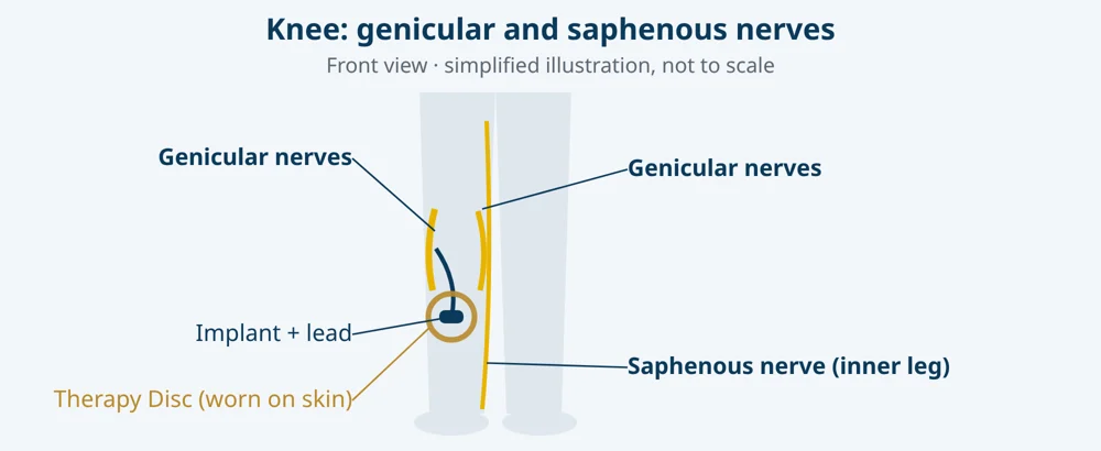 Simplified illustration: genicular and saphenous nerves, with lead, micro-implant and Therapy Disc