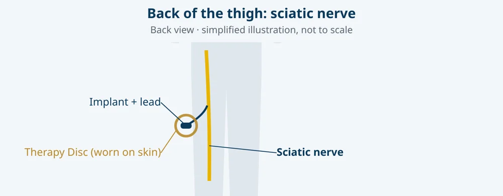 Simplified illustration: the sciatic nerve, with lead, micro-implant and Therapy Disc