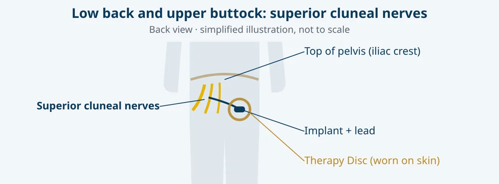 Simplified illustration: superior cluneal nerves, with lead, micro-implant and Therapy Disc