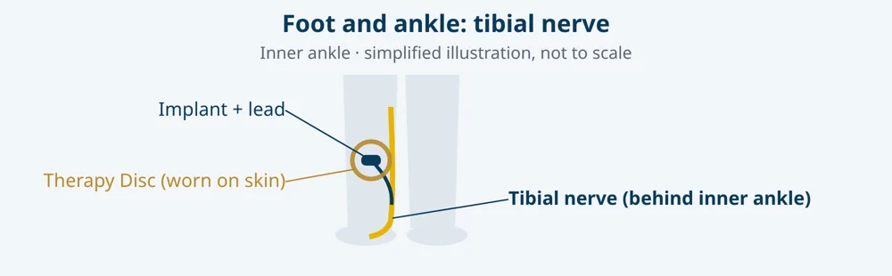 Simplified illustration: tibial nerve (foot and ankle), with lead, micro-implant and Therapy Disc