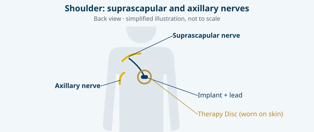 Simplified illustration: suprascapular and axillary nerves, with lead, micro-implant and Therapy Disc